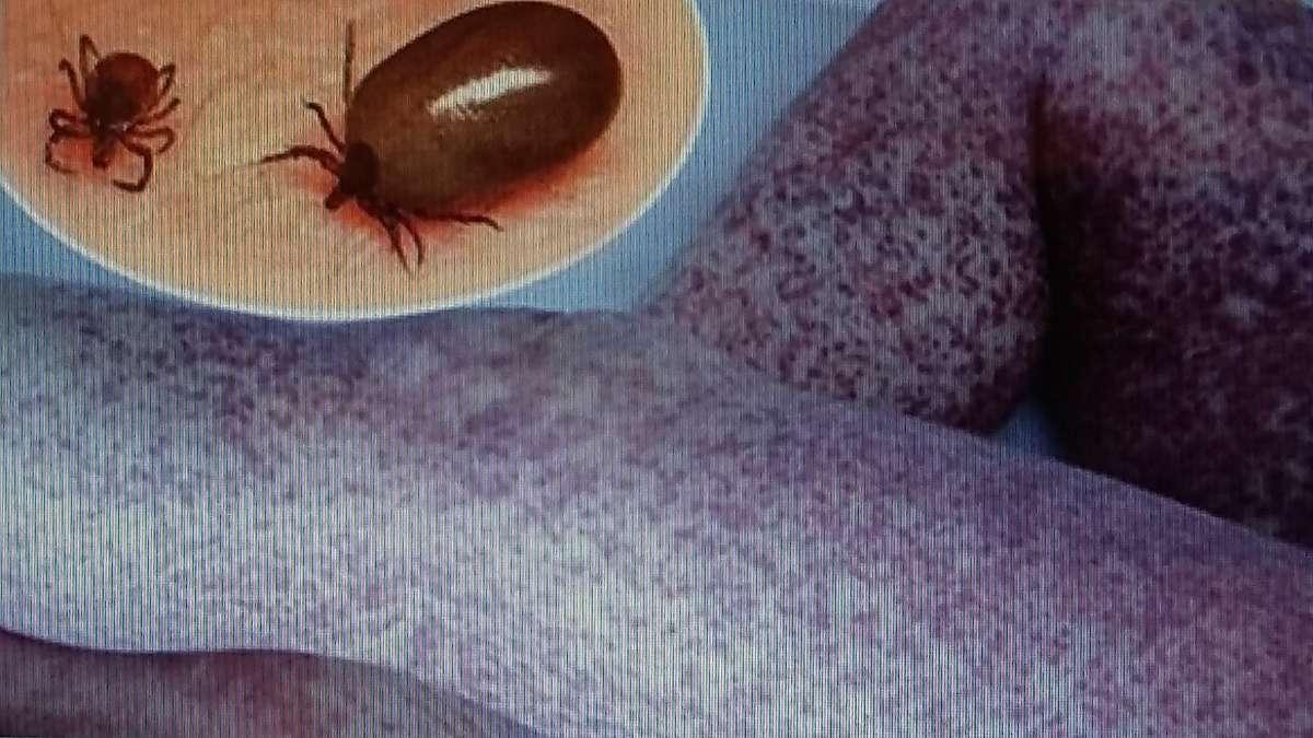 Krími-kongói vérzéses láz - CCHF